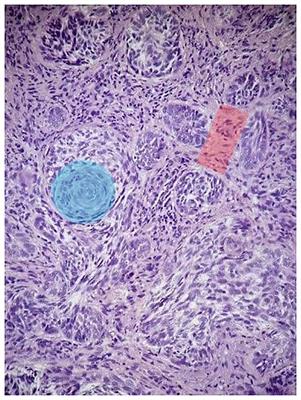 An unusual occurrence of multiple primary malignant neoplasms: a case report and narrative review